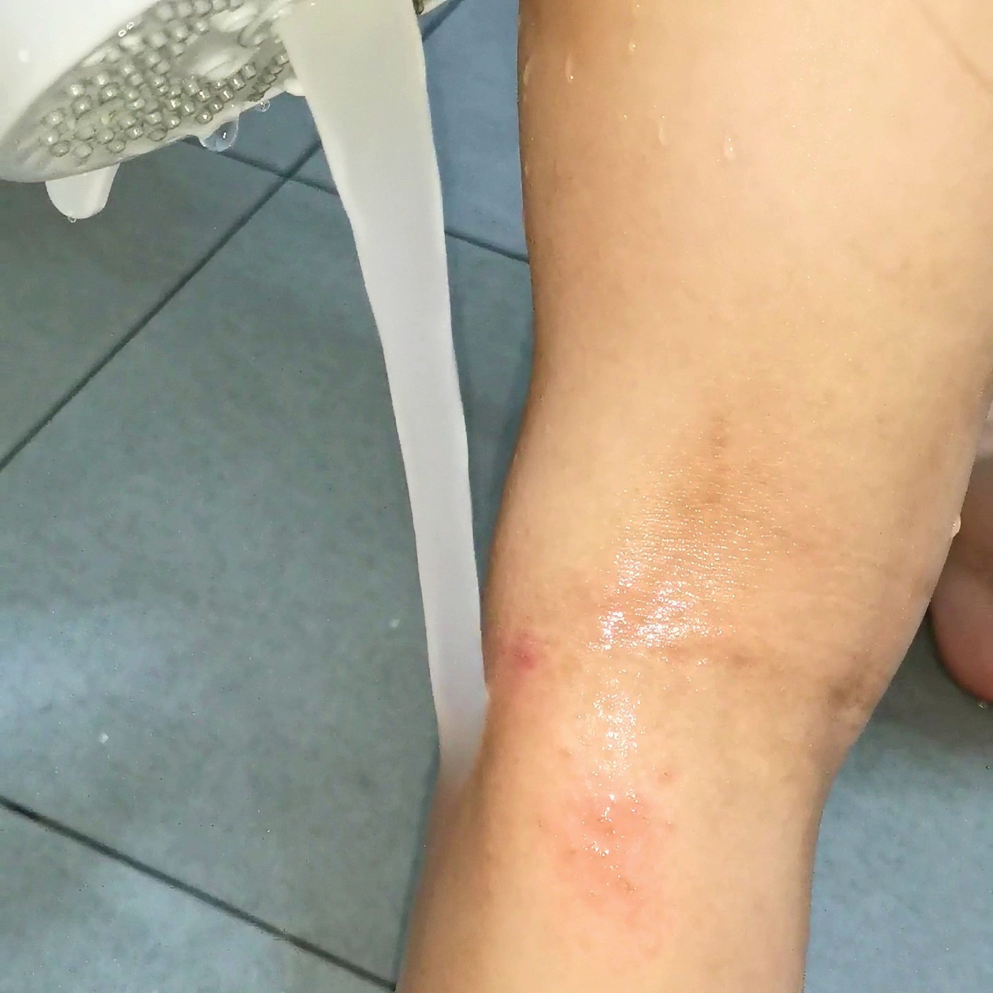 aerbubblr eczema