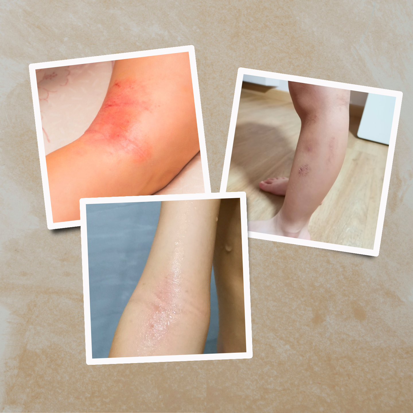 eczema collage